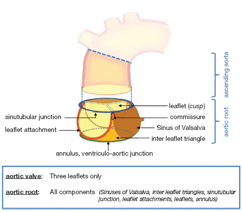 Anatomy Of The Aortic Root Implications For Valve Sparing Surgery