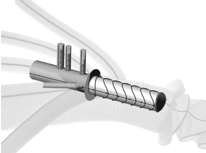 graft stent protocol