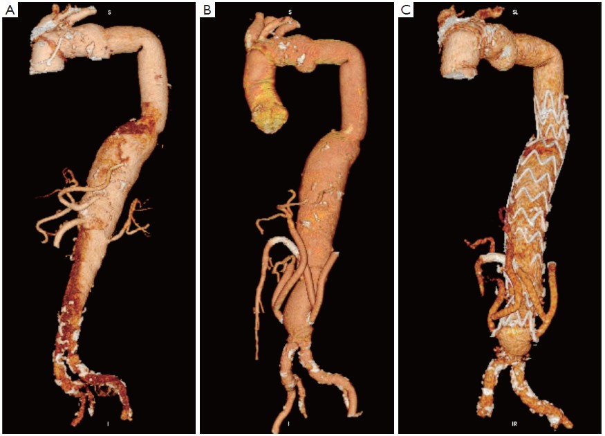 Clinical Outcomes Of Hybrid Repair For Thoracoabdominal Aortic
